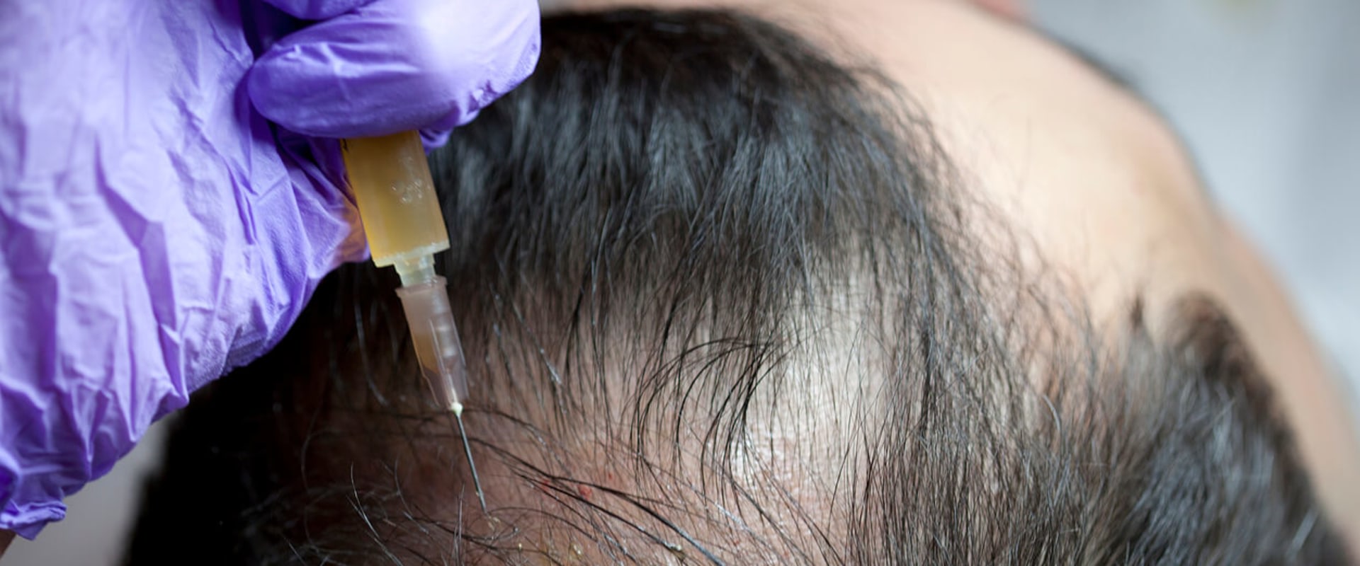 What Are PRP Injections and How Can They Help With Hair Loss Treatments?