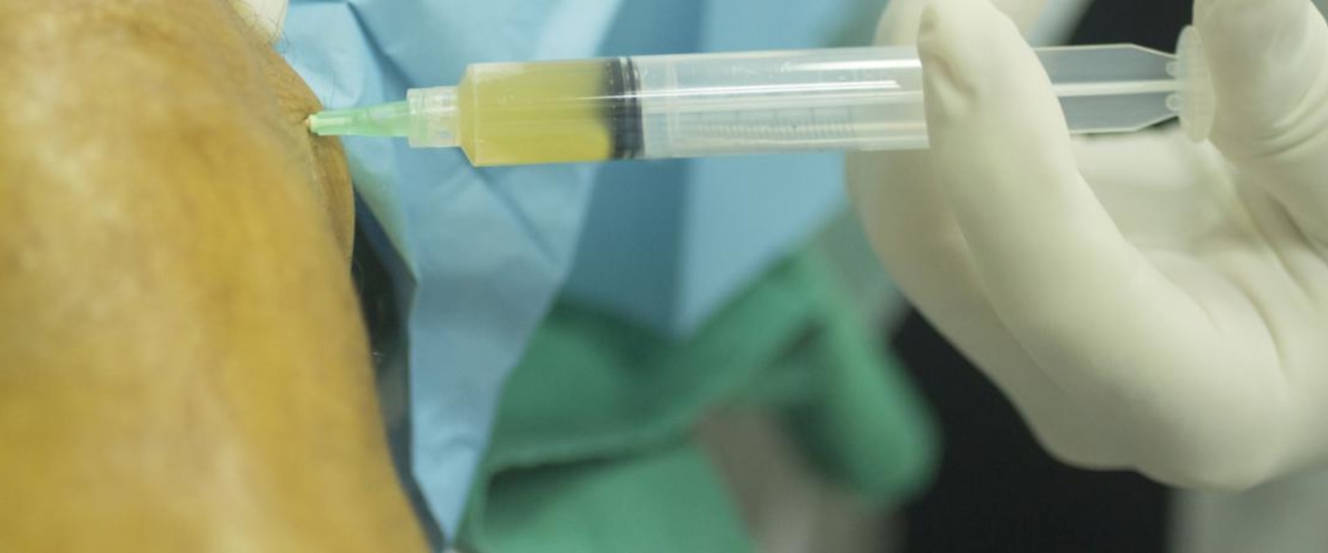 Does PRP Injections Really Work? An Expert's Perspective