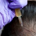 How Many PRP Injections Are Needed for Hair Growth?