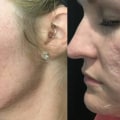 How Long After PRP Injections Can You See Results?