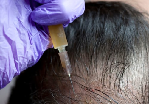 What Are PRP Injections and How Can They Help With Hair Loss Treatments?