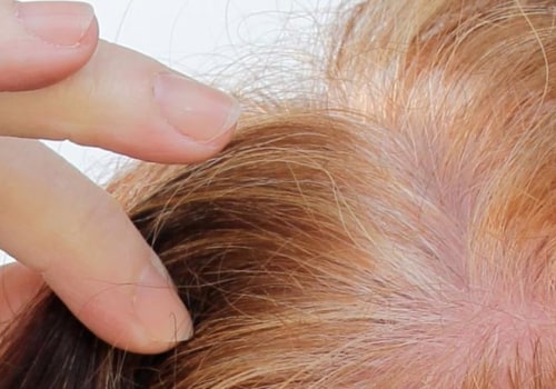 The Benefits of PRP Treatment for Hair Loss